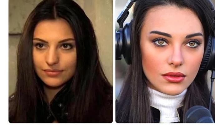 Tuvana Türkay Estetiksiz Eski ve Estetikli Yeni Hali