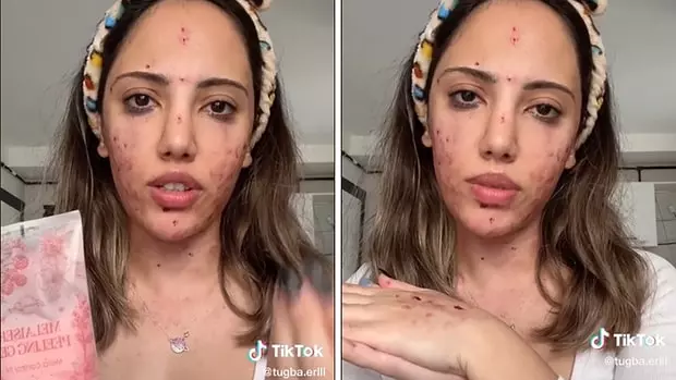 Ece Ronay Sivilce Kremi Olayı (Yağmur Eroğlu) Gerçek mi?