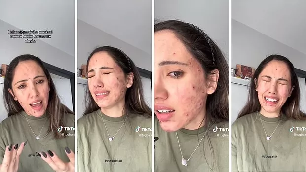 Ece Ronay Sivilce Kremi Olayı (Yağmur Eroğlu) Gerçek mi?